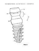 CONDENSING SKELETAL IMPLANT THAT FACILITATE INSERTIONS diagram and image