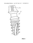 CONDENSING SKELETAL IMPLANT THAT FACILITATE INSERTIONS diagram and image