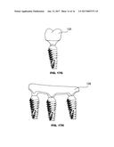 CONDENSING SKELETAL IMPLANT THAT FACILITATE INSERTIONS diagram and image