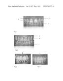 GINGIVAL INDEXING DEVICE AND METHOD FOR INDEXING THE GINGIVA diagram and image