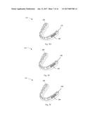 SYSTEMS, APPARATUSES AND METHODS FOR SUBSTANCE DELIVERY FROM DENTAL     APPLIANCE diagram and image