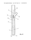 PERCUTANEOUS TRANSLUMINAL ANGIOPLASTY DEVICE WITH INTEGRAL EMBOLIC FILTER diagram and image