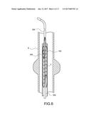 STENT-GRAFT diagram and image