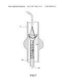 STENT-GRAFT diagram and image