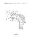 STENT-GRAFT diagram and image