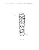 ENDOPROSTHESIS FOR ENDOVASCULAR TREATMENT OF THORACIC-ABDOMINAL AORTIC     ANEURYSMS OR DISSECTIONS AND ENDOPROSTHESIS FOR ENDOVASCULAR TREATMENT OF     ABDOMINAL AORTIC ANEURYSMS OR DISSECTIONS WHICH COMPROMISE THE ILIAC     ARTERIES diagram and image