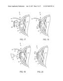 METHOD OF ALTERING THE REFRACTIVE PROPERTIES OF AN EYE diagram and image