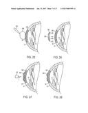 METHOD OF ALTERING THE REFRACTIVE PROPERTIES OF AN EYE diagram and image