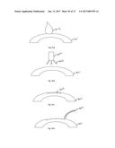 METHOD OF ALTERING THE REFRACTIVE PROPERTIES OF AN EYE diagram and image