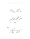 METHOD OF ALTERING THE REFRACTIVE PROPERTIES OF AN EYE diagram and image