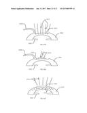 METHOD OF ALTERING THE REFRACTIVE PROPERTIES OF AN EYE diagram and image