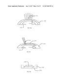 METHOD OF ALTERING THE REFRACTIVE PROPERTIES OF AN EYE diagram and image