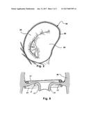 ARRANGEMENT, A LOOP-SHAPED SUPPORT, A PROSTHETIC HEART VALVE AND A METHOD     OF REPAIRING OR REPLACING A NATIVE HEART VALVE diagram and image