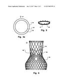 ARRANGEMENT, A LOOP-SHAPED SUPPORT, A PROSTHETIC HEART VALVE AND A METHOD     OF REPAIRING OR REPLACING A NATIVE HEART VALVE diagram and image