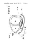 IMPLANTABLE DEVICE FOR THE LOCATIONALLY ACCURATE DELIVERY AND     ADMINISTRATION OF SUBSTANCES INTO THE PERICARDIUM OR ONTO THE SURFACE OF     THE HEART diagram and image