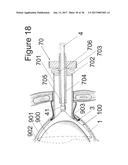 IMPLANTABLE DEVICE FOR THE LOCATIONALLY ACCURATE DELIVERY AND     ADMINISTRATION OF SUBSTANCES INTO THE PERICARDIUM OR ONTO THE SURFACE OF     THE HEART diagram and image