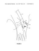 APPARATUS AND METHOD FOR HEART VALVE REPAIR diagram and image