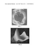 Joint Arthroplasty Devices and Surgical Tools diagram and image