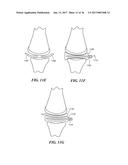 Joint Arthroplasty Devices and Surgical Tools diagram and image