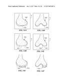 Joint Arthroplasty Devices and Surgical Tools diagram and image