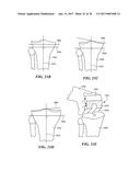 Joint Arthroplasty Devices and Surgical Tools diagram and image