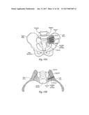 SYSTEMS, DEVICE, AND METHODS FOR JOINT FUSION diagram and image