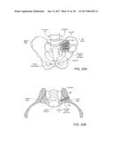 SYSTEMS, DEVICE, AND METHODS FOR JOINT FUSION diagram and image