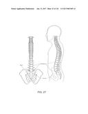 SYSTEMS, DEVICE, AND METHODS FOR JOINT FUSION diagram and image