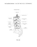 SYSTEMS, DEVICE, AND METHODS FOR JOINT FUSION diagram and image