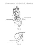 SYSTEMS, DEVICE, AND METHODS FOR JOINT FUSION diagram and image