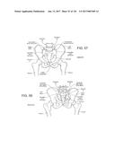 SYSTEMS, DEVICE, AND METHODS FOR JOINT FUSION diagram and image