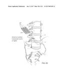 SYSTEMS, DEVICE, AND METHODS FOR JOINT FUSION diagram and image