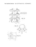 SYSTEMS, DEVICE, AND METHODS FOR JOINT FUSION diagram and image