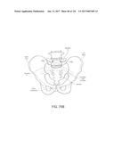 SYSTEMS, DEVICE, AND METHODS FOR JOINT FUSION diagram and image