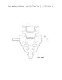 SYSTEMS, DEVICE, AND METHODS FOR JOINT FUSION diagram and image