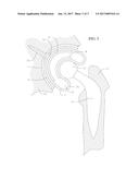 IMPLANTABLE ENCAPSULATED PROSTHETIC JOINT MODULE diagram and image