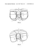 ARTIFICIAL KNEE JOINT diagram and image