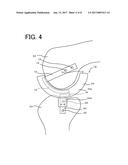 INTERNAL JOINT CAVITY EXPANDER diagram and image