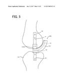 INTERNAL JOINT CAVITY EXPANDER diagram and image