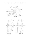 Patient Selectable Knee Arthroplasty Devices diagram and image