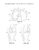 Patient Selectable Knee Arthroplasty Devices diagram and image