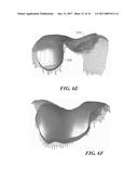 Patient Selectable Knee Arthroplasty Devices diagram and image