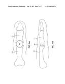 HAMMER TOE IMPLANT diagram and image