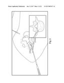 SYSTEM AND METHOD FOR PERFORMING PERCUTANEOUS SPINAL INTERBODY FUSION diagram and image