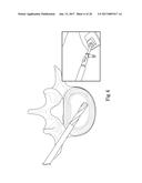 SYSTEM AND METHOD FOR PERFORMING PERCUTANEOUS SPINAL INTERBODY FUSION diagram and image