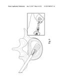 SYSTEM AND METHOD FOR PERFORMING PERCUTANEOUS SPINAL INTERBODY FUSION diagram and image