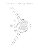 SYSTEM AND METHOD FOR PERFORMING PERCUTANEOUS SPINAL INTERBODY FUSION diagram and image