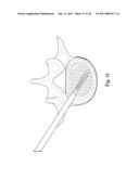 SYSTEM AND METHOD FOR PERFORMING PERCUTANEOUS SPINAL INTERBODY FUSION diagram and image