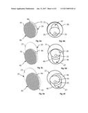 FACET JOINT PROSTHESIS diagram and image