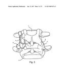 Linked Bilateral Spinal Facet Implants and Methods of Use diagram and image